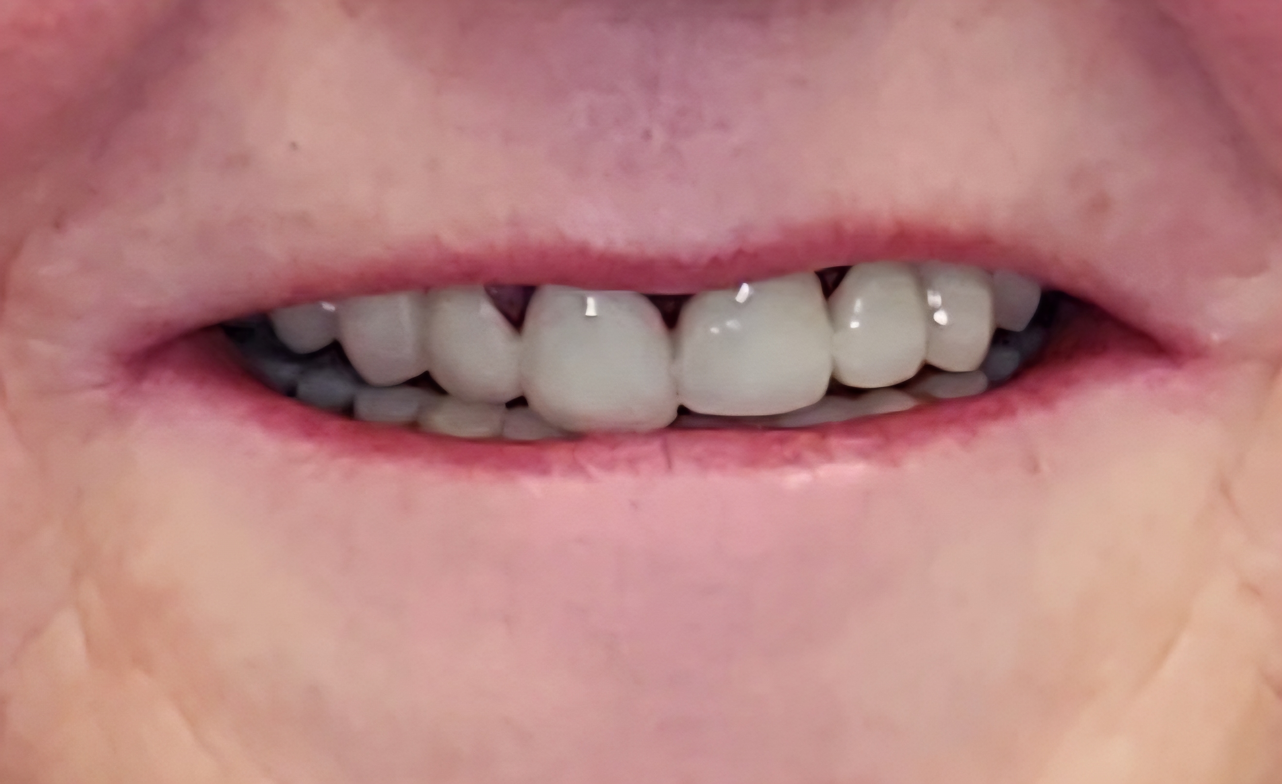 All-on-4 dental implant before treatment at Elm Ridge Implant and Family Dentistry in Killeen, TX